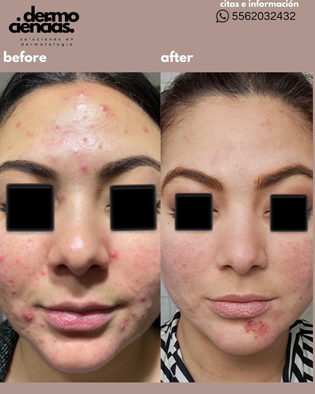 Caso de Exito 2 Dermociencias - Tratamiento de acné en CDMX Caso de Exito 2 Dermociencias - Tratamiento de acné en CDMX