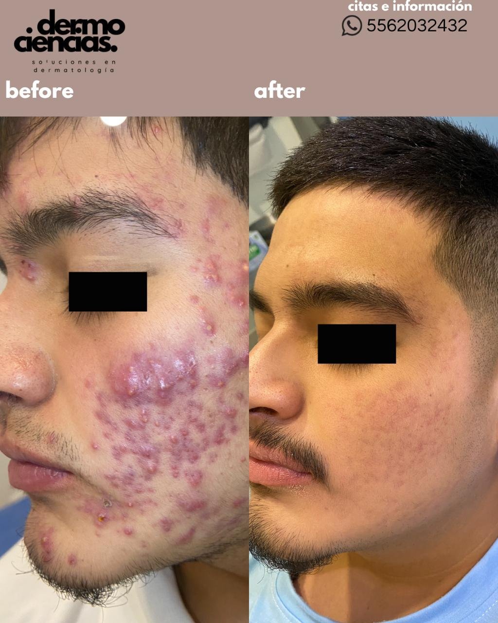 Caso de Exito 3 Dermociencias - Tratamiento de acné en CDMX Caso de Exito 3 Dermociencias - Tratamiento de acné en CDMX