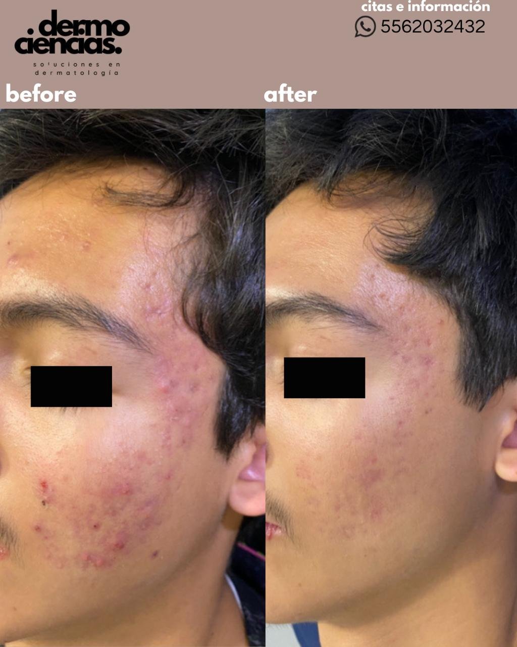 Caso de Exito 4 Dermociencias - Tratamiento de acné en CDMX Caso de Exito 4 Dermociencias - Tratamiento de acné en CDMX