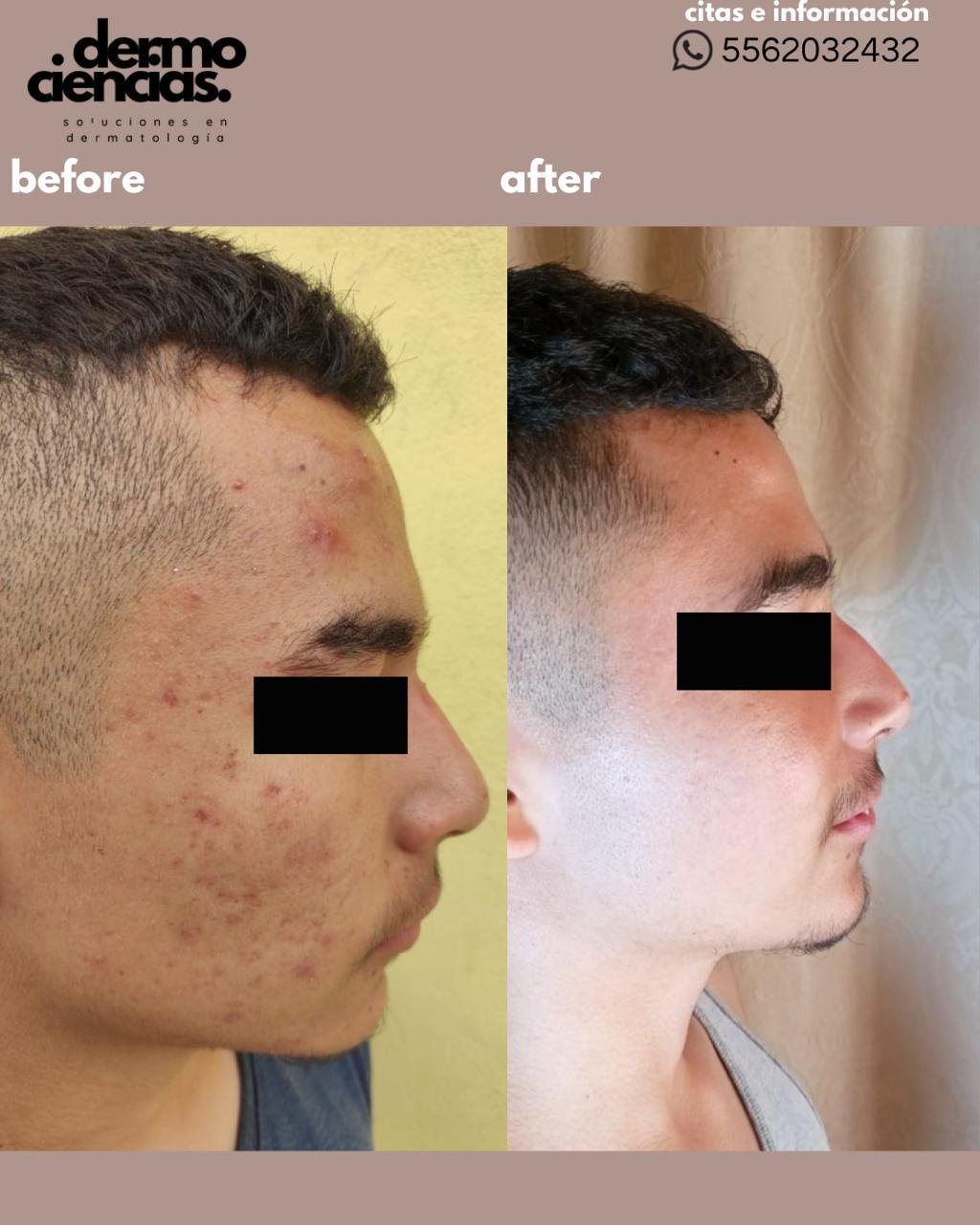Caso de Exito 5 Dermociencias - Tratamiento de acné en CDMX Caso de Exito 5 Dermociencias - Tratamiento de acné en CDMX