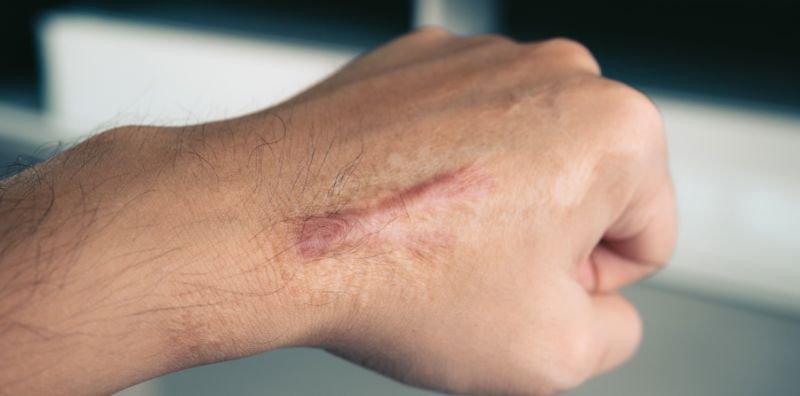 Especialista en cicatrices en CDMX