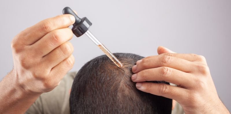 Tratamiento con minoxidil en CDMX Tratamiento con minoxidil en CDMX