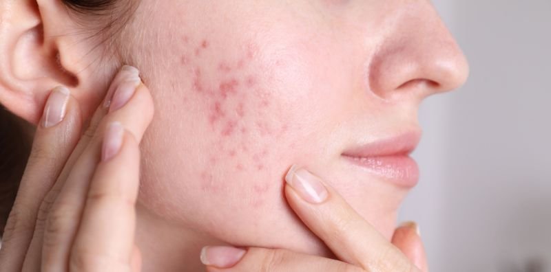 Tratamiento para acné en CDMX Tratamiento para acné en CDMX